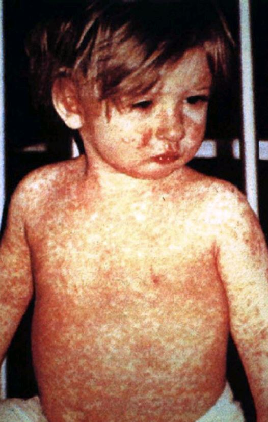 measles